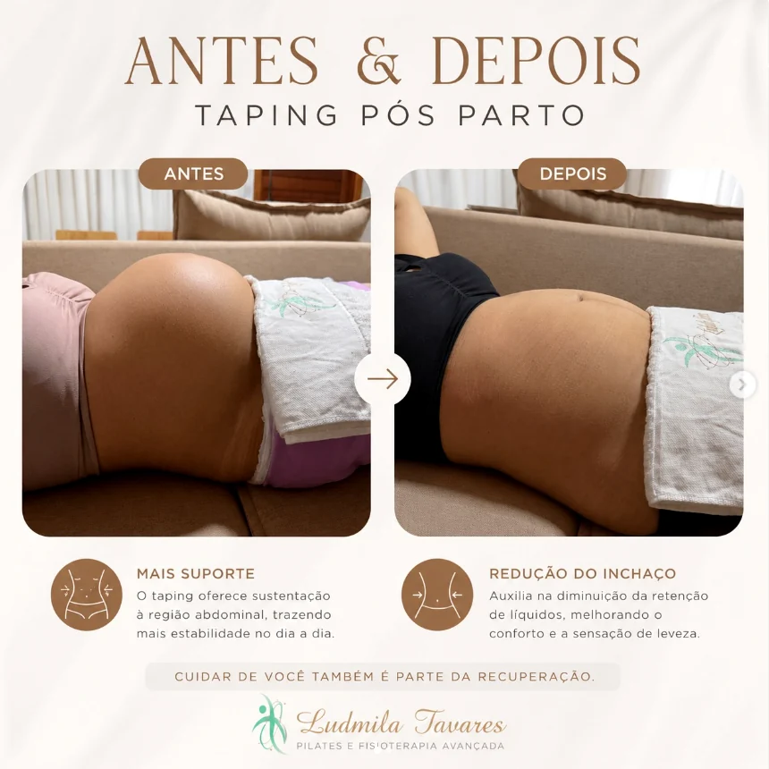Taping pós-parto antes e depois